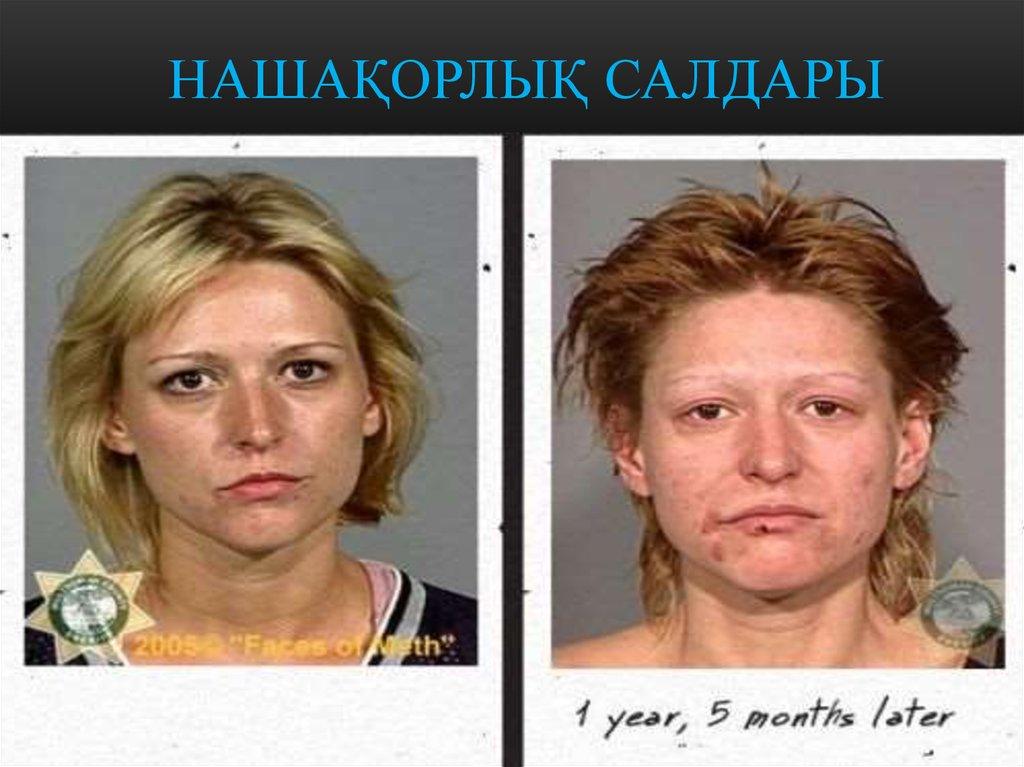 Нашақорлық салдары