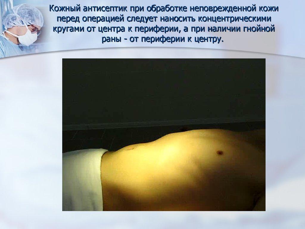 Кожный антисептик при обработке неповрежденной кожи перед операцией следует наносить концентрическими кругами от центра к периферии, а п