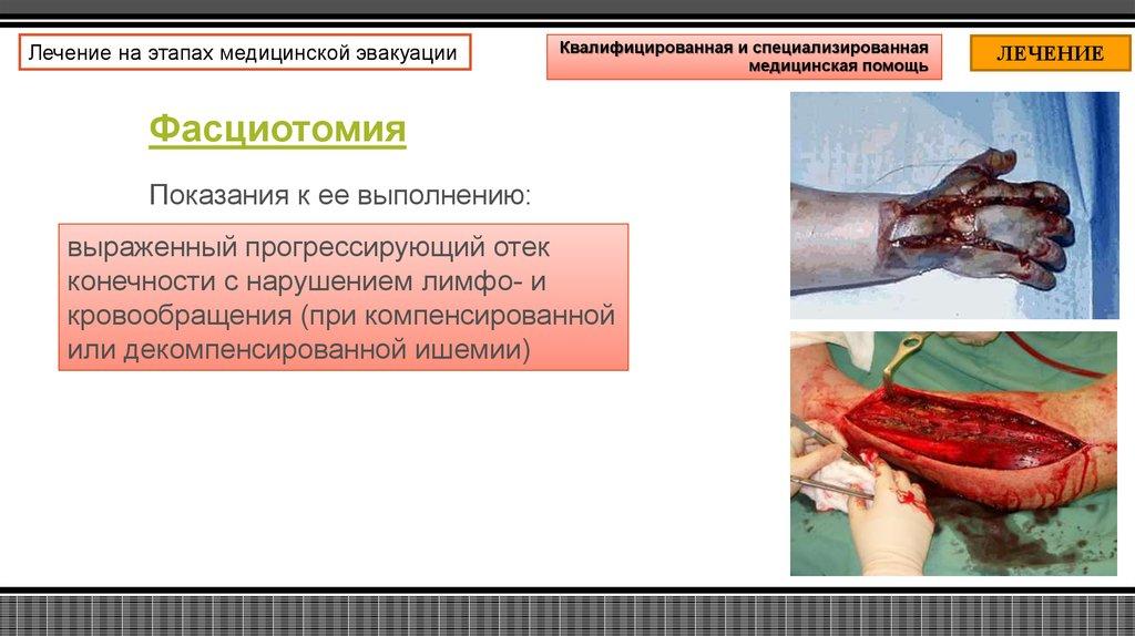 Фасциотомия