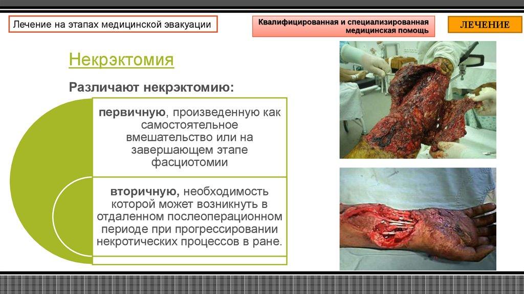 Некрэктомия