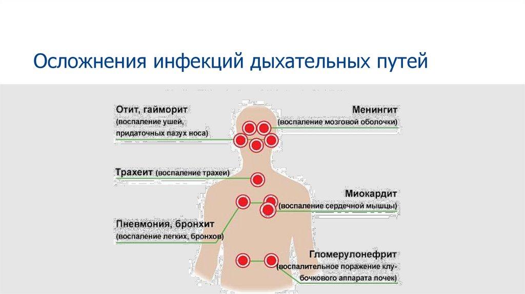 Осложнения инфекций дыхательных путей