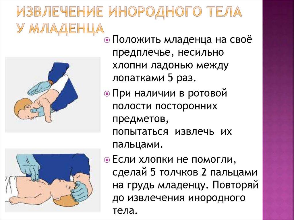 Извлечение инородного тела у младенца